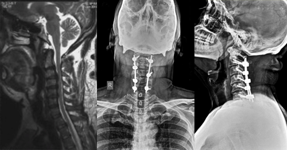 Laminectomy